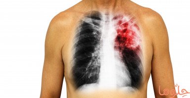 أسباب وأعراض التهاب الرئة pneumonia