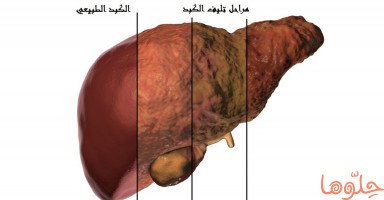 أسباب وأعراض تليف الكبد وعلاج تشمّع الكبد
