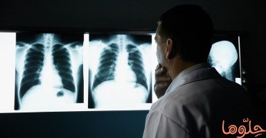 أعراض وأسباب سرطان الرئة (Lung Cancer) وطرق العلاج
