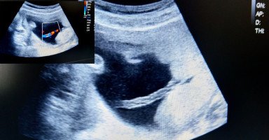 أعراض التفاف الحبل السري حول الجنين وأسبابه