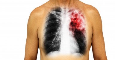 أسباب وأعراض التهاب الرئة pneumonia