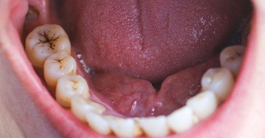 تفسير رؤية تسوس الأسنان في المنام بالتفصيل
