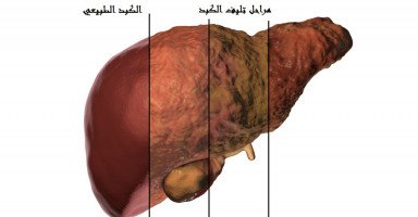 أسباب وأعراض تليف الكبد وعلاج تشمّع الكبد