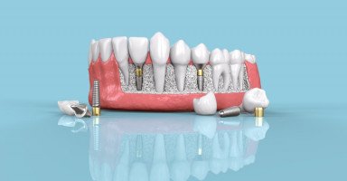 أنواع تركيبات الأسنان الثابتة والمتحركة