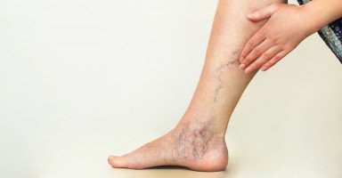 علاجات دوالي الساقين عند النساء وأسبابها