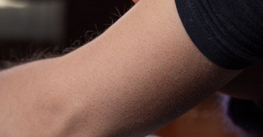 طرق علاج جلد الوزة وأسباب التقرّن الشَّعري