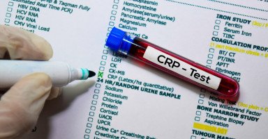 قراءة تحليل CRP وعلى ماذا يدل تحليل بروتين سي التفاعلي
