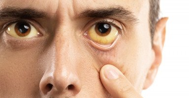 أسباب اصفرار العين وطرق تشخيص وعلاج صفار العيون