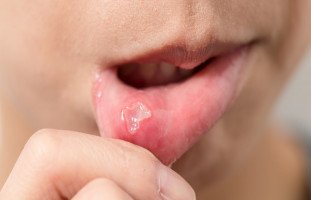علاج تقرحات الفم في المنزل وأسباب القرح الفموية
