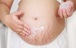 علامات التمدد عند الحامل وكيف أتجنب تشققات الحمل؟