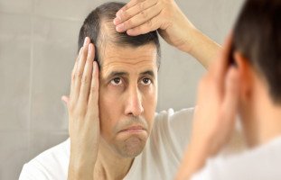 علاج تساقط الشعر عند الرجال وأسباب الصلع