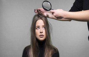 علاج قشرة الشعر وأسباب ظهور القشرة
