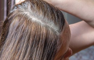 علاج نقص صبغة الميلانين في الشعر