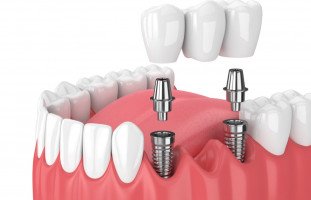 عملية زراعة الأسنان المخاطر والتكاليف