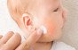 أسباب ظهور حبوب في وجه الرضيع وطرق علاجها